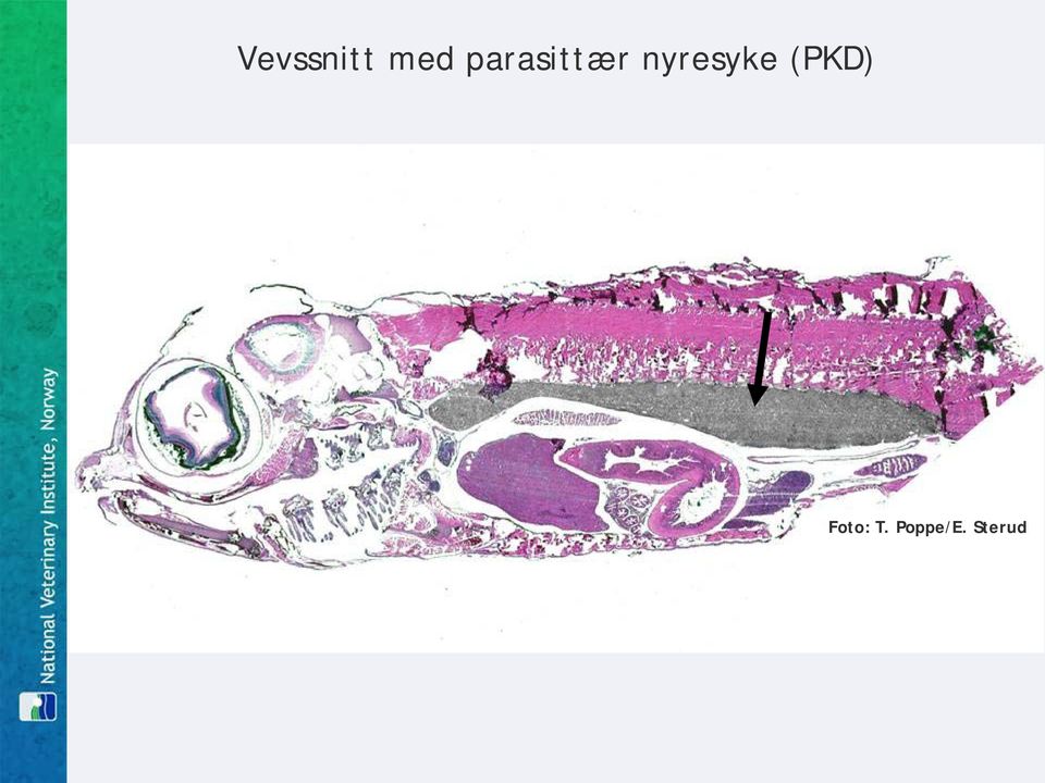 nyresyke (PKD)