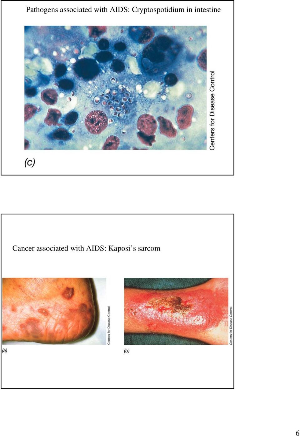 intestine Cancer