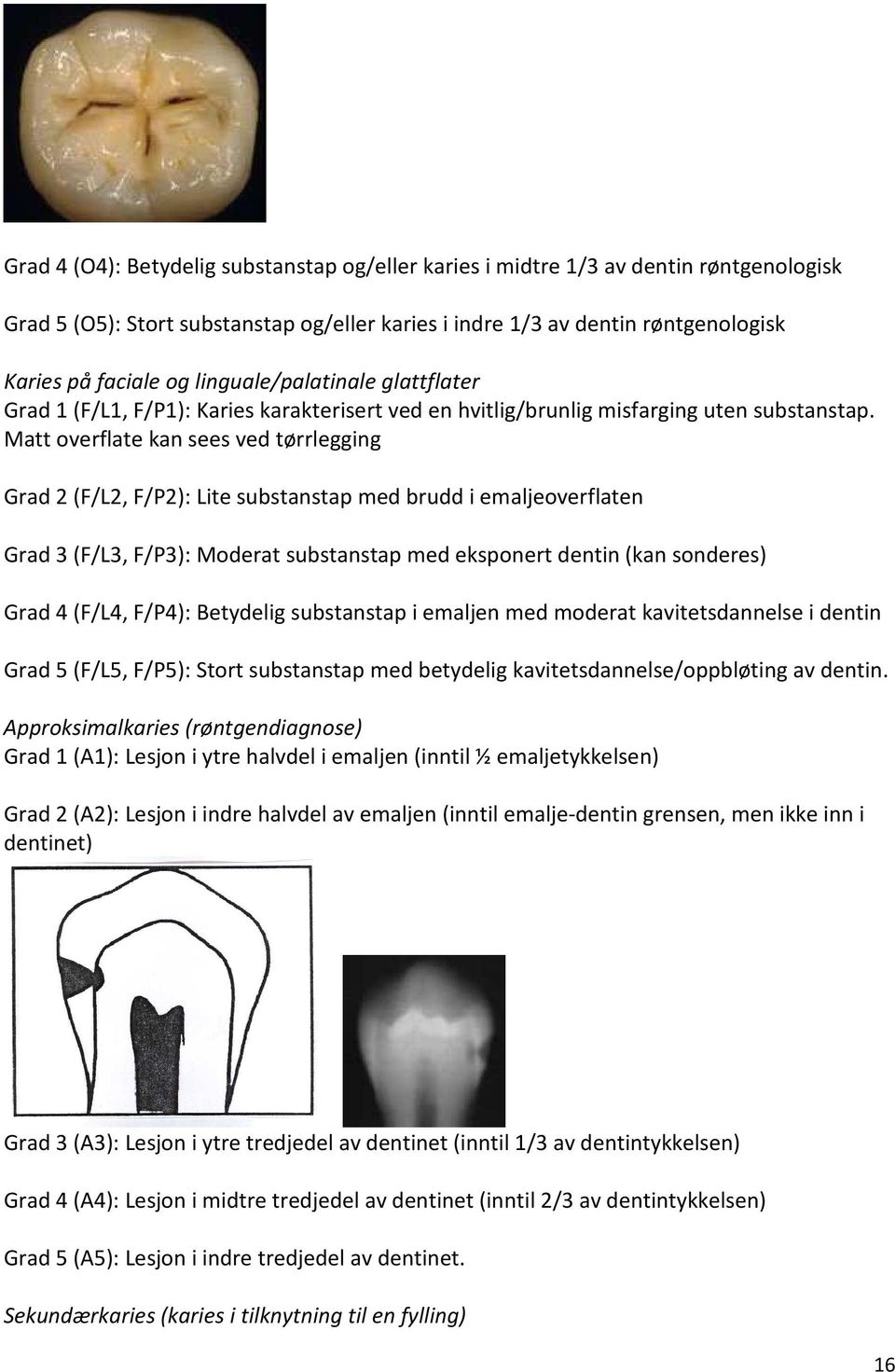 Matt overflate kan sees ved tørrlegging Grad 2 (F/L2, F/P2): Lite substanstap med brudd i emaljeoverflaten Grad 3 (F/L3, F/P3): Moderat substanstap med eksponert dentin (kan sonderes) Grad 4 (F/L4,