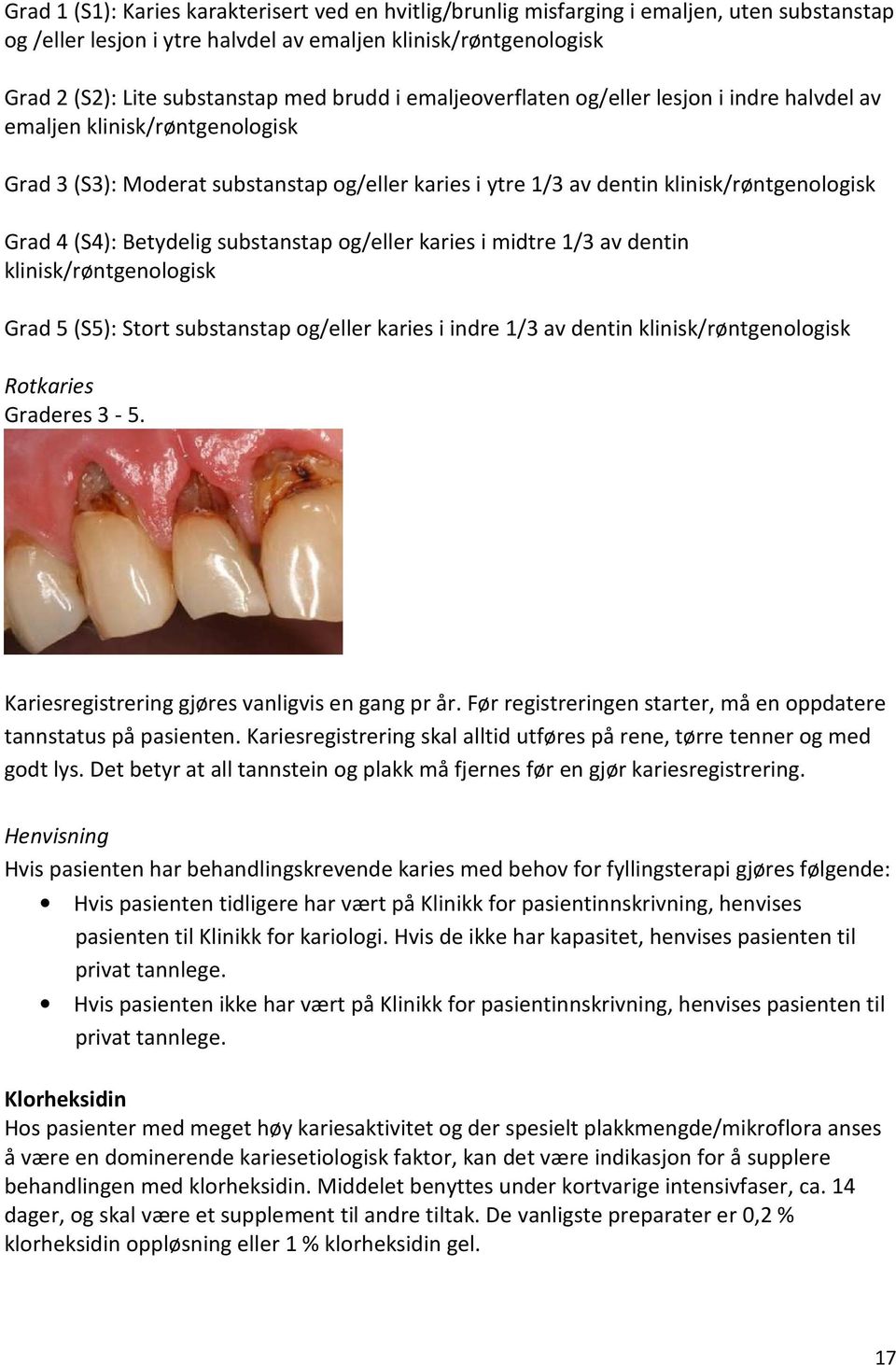 Betydelig substanstap og/eller karies i midtre 1/3 av dentin klinisk/røntgenologisk Grad 5 (S5): Stort substanstap og/eller karies i indre 1/3 av dentin klinisk/røntgenologisk Rotkaries Graderes 3-5.