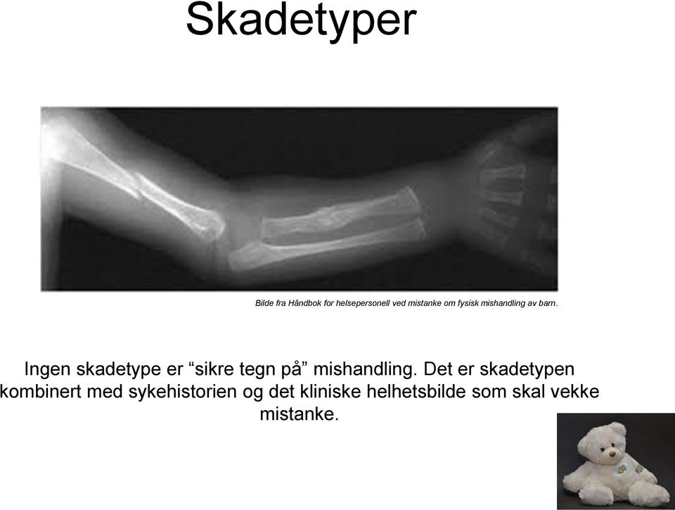 Ingen skadetype er sikre tegn på mishandling.