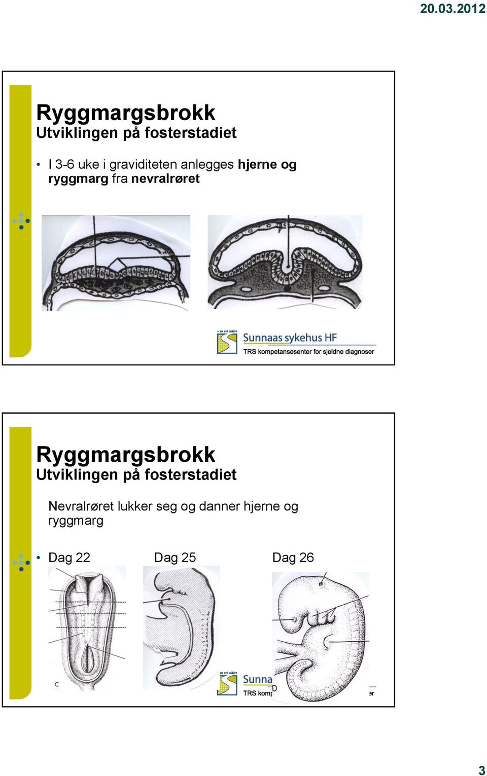 Ryggmargsbrokk Utviklingen på fosterstadiet Nevralrøret