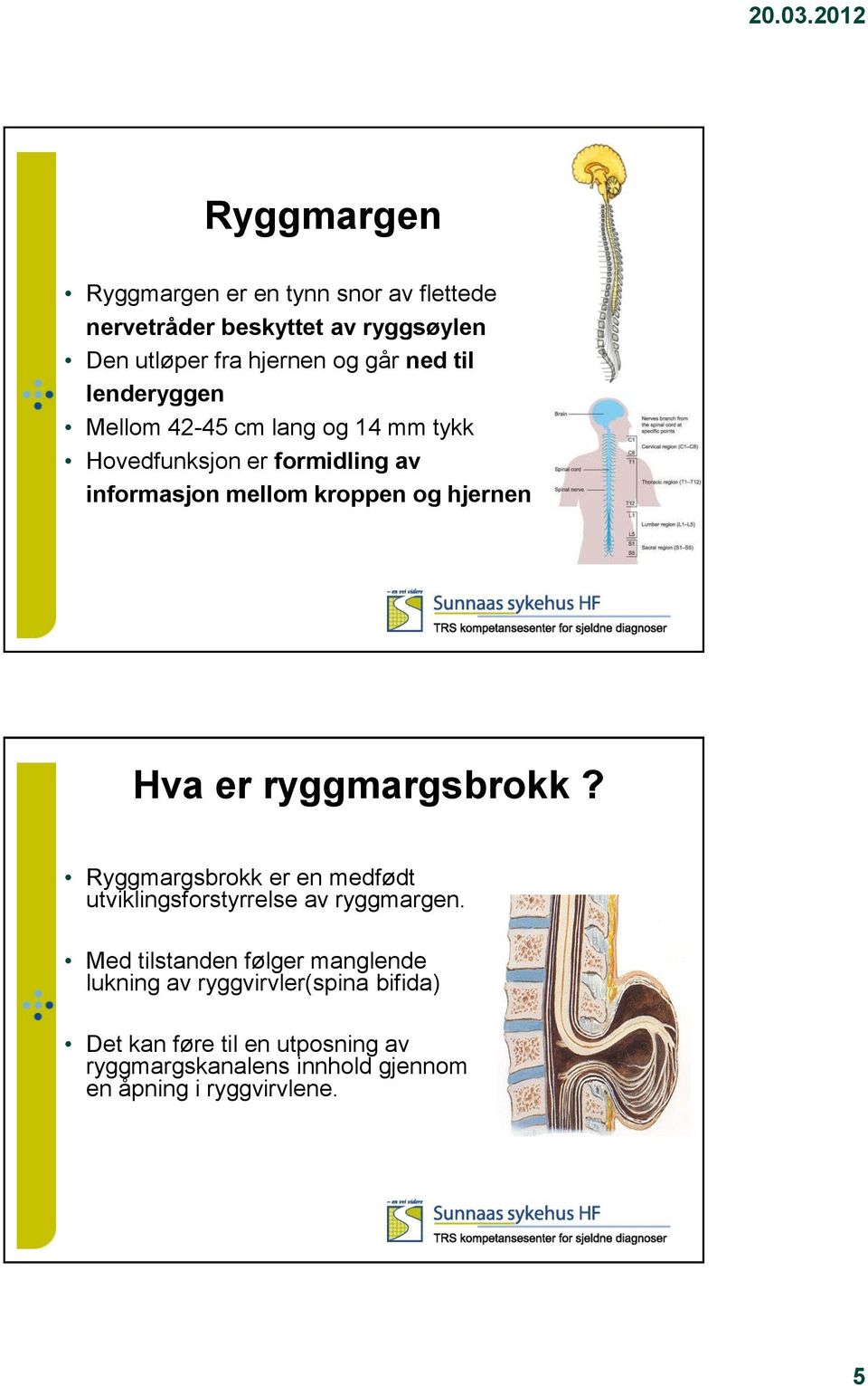 er ryggmargsbrokk? Ryggmargsbrokk er en medfødt utviklingsforstyrrelse av ryggmargen.