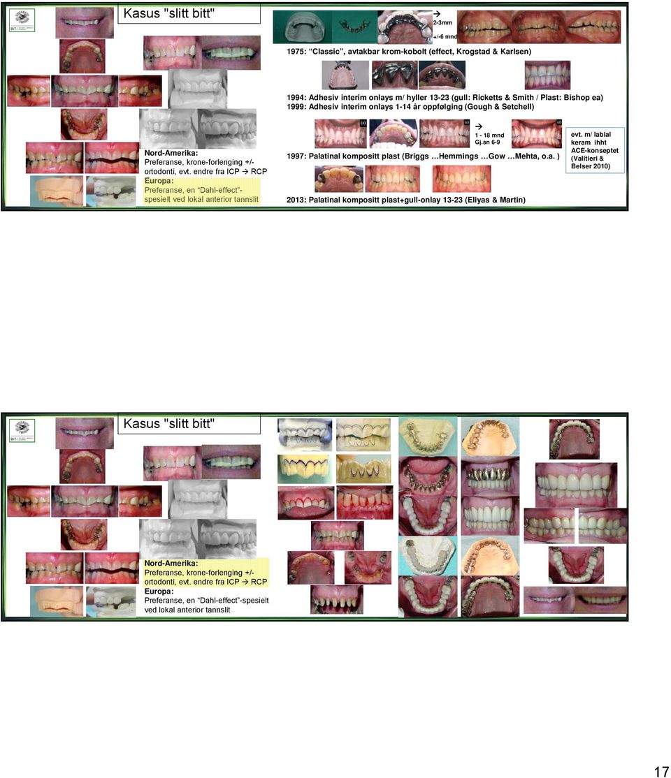 endre fra ICP RCP Europa: Preferanse, en Dahl-effect - spesielt ved lokal anterior tannslit 1-18 mnd Gj.sn 6-9 1997: Palatinal kompositt plast (Briggs Hemmings Gow Mehta, o.a. ) 2013: Palatinal kompositt plast+gull-onlay 13-23 (Eliyas & Martin) evt.