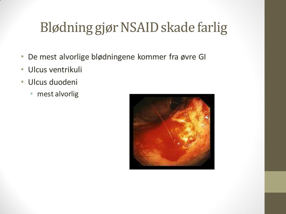 blødningene kommer fra øvre GI