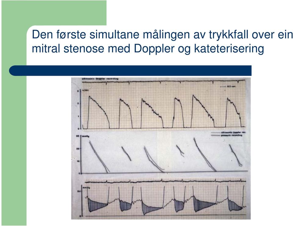 over ein mitral stenose