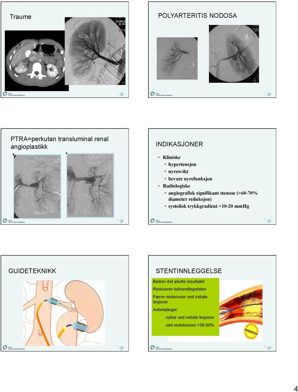 systolisk trykkgradient >10-20 mmhg GUIDETEKNIKK STENTINNLEGGELSE Bedrer det akutte resultatet Reduserer