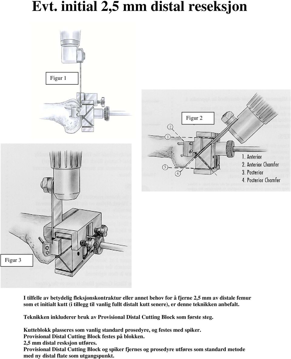 Teknikken inkluderer bruk av Provisional Distal Cutting Block som første steg. Kutteblokk plasseres som vanlig standard prosedyre, og festes med spiker.