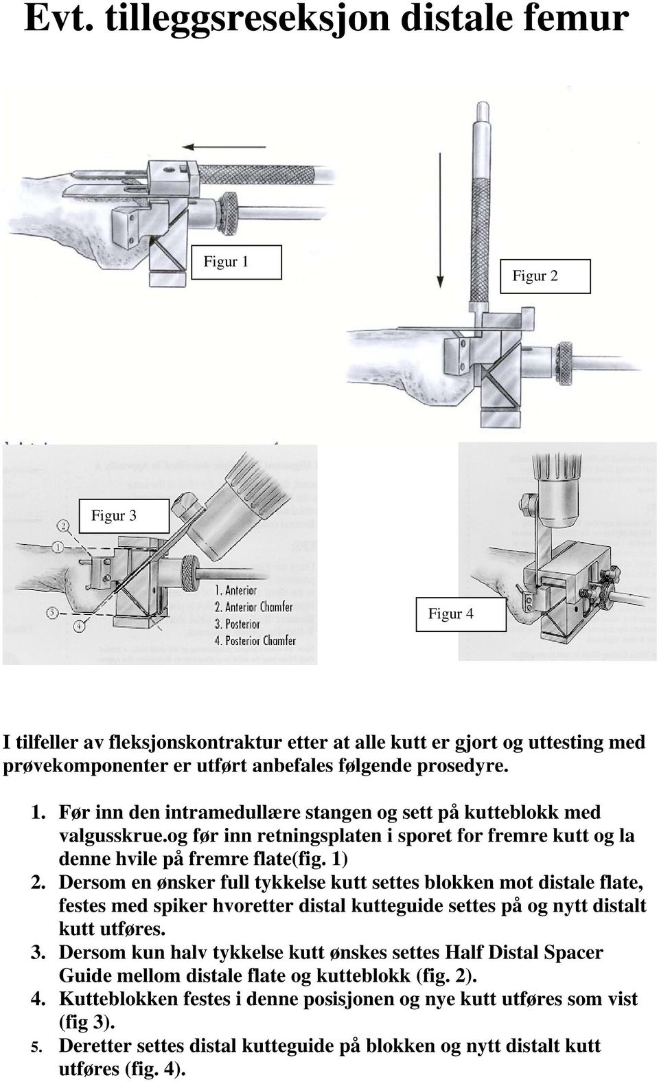 Dersom en ønsker full tykkelse kutt settes blokken mot distale flate, festes med spiker hvoretter distal kutteguide settes på og nytt distalt kutt utføres. 3.