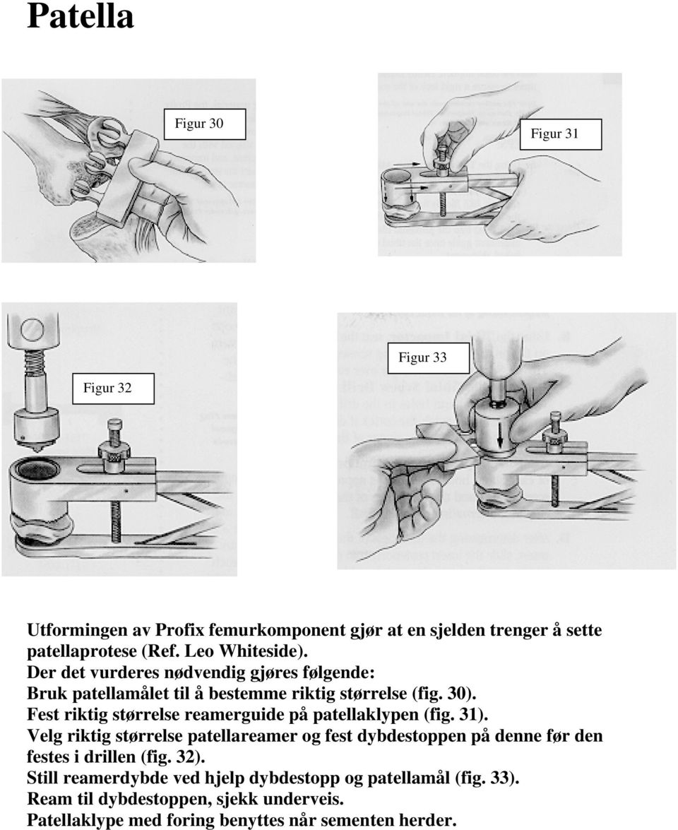 Fest riktig størrelse reamerguide på patellaklypen (fig. 31).