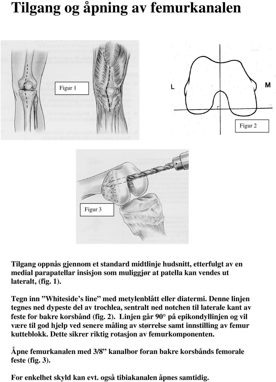 Denne linjen tegnes ned dypeste del av trochlea, sentralt ned notchen til laterale kant av feste for bakre korsbånd (fig. 2).