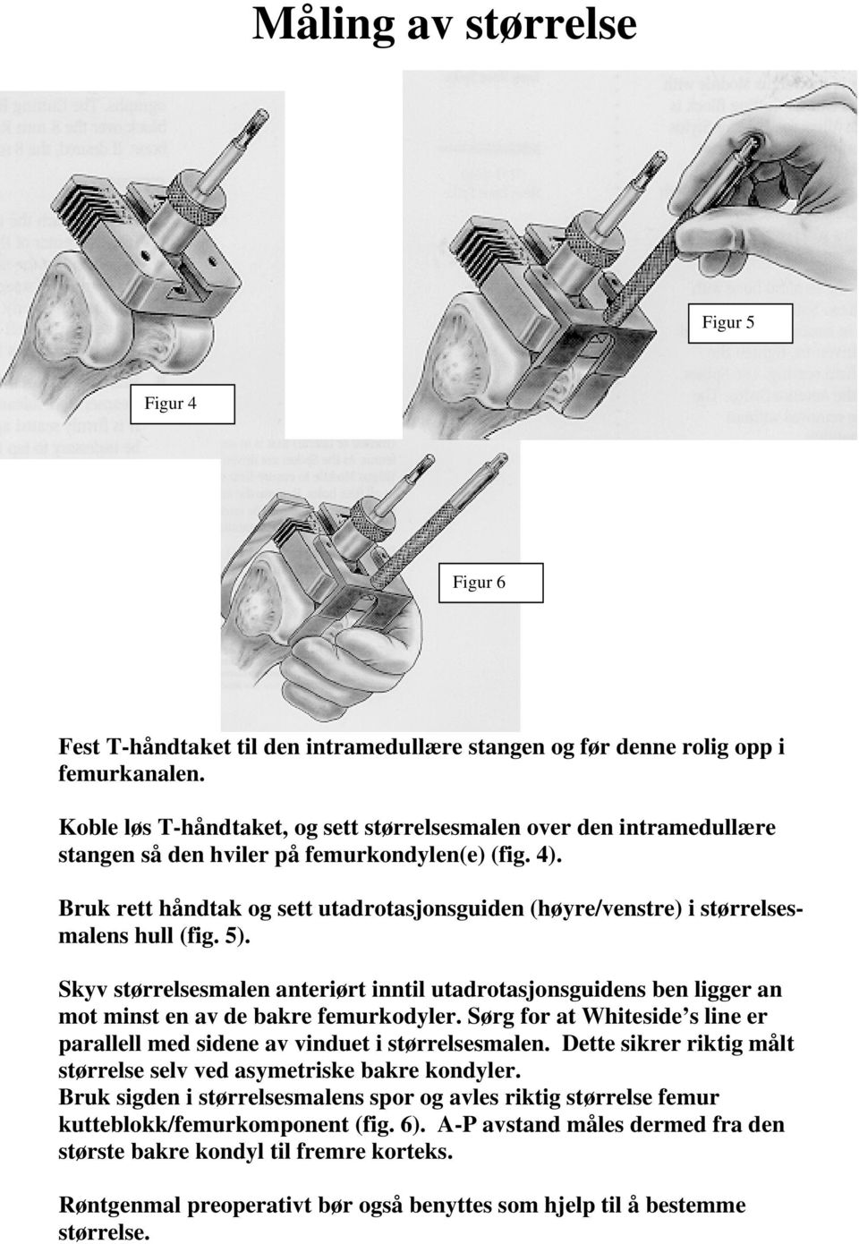 Bruk rett håndtak og sett utadrotasjonsguiden (høyre/venstre) i størrelsesmalens hull (fig. 5).