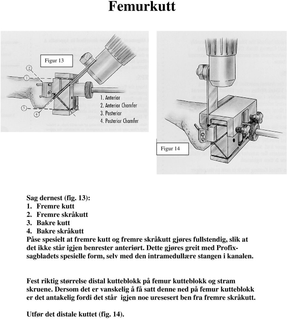 Dette gjøres greit med Profixsagbladets spesielle form, selv med den intramedullære stangen i kanalen.