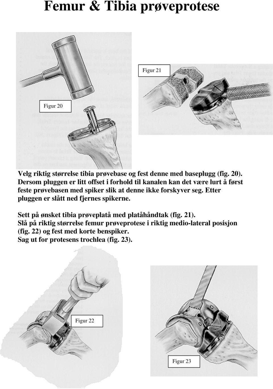 seg. Etter pluggen er slått ned fjernes spikerne. Sett på ønsket tibia prøveplatå med platåhåndtak (fig. 21).