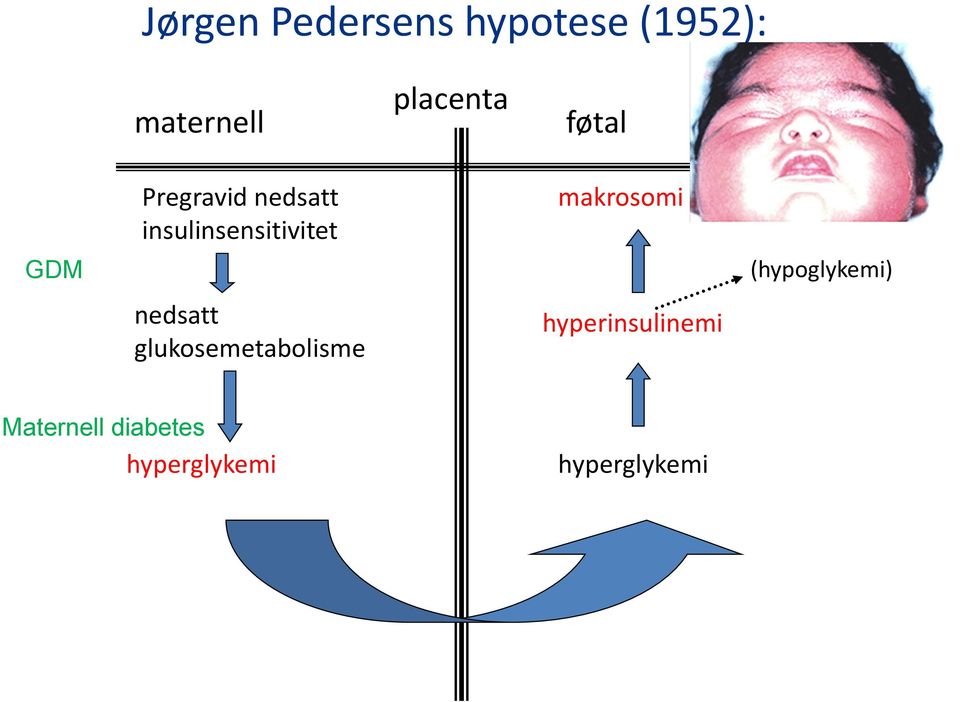 nedsatt glukosemetabolisme makrosomi hyperinsulinemi