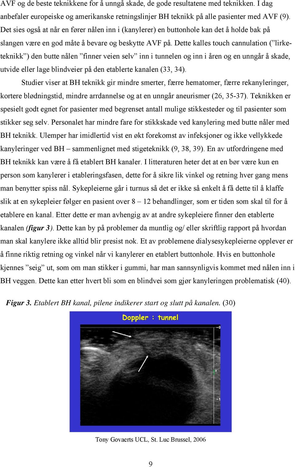 Dette kalles touch cannulation ( lirketeknikk ) den butte nålen finner veien selv inn i tunnelen og inn i åren og en unngår å skade, utvide eller lage blindveier på den etablerte kanalen (33, 34).