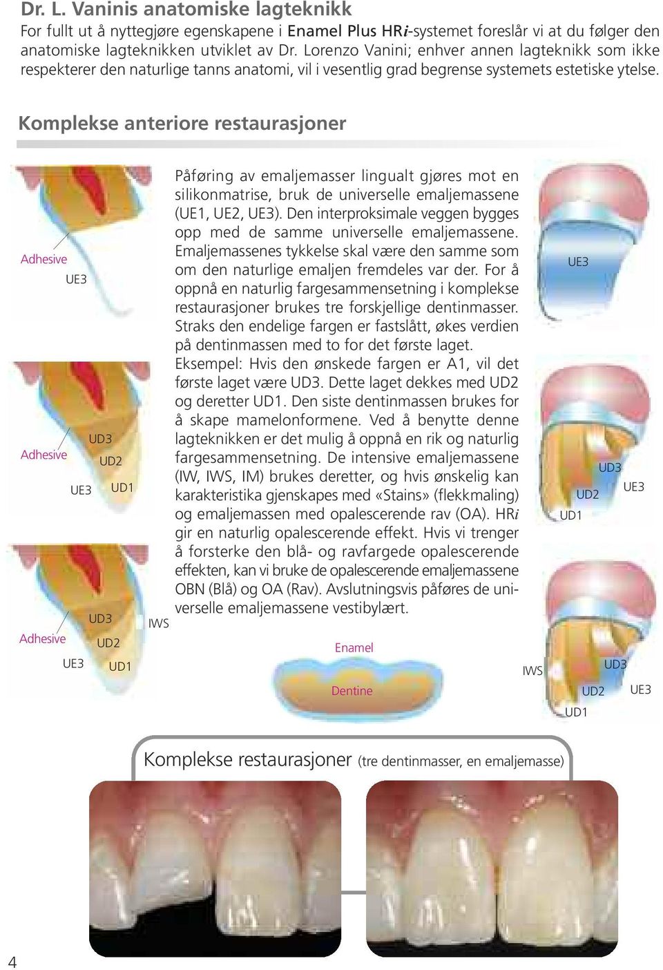 Komplekse anteriore restaurasjoner Adhesive UE3 Adhesive UD2 UE3 UD1 Adhesive UD2 UE3 UD1 IWS Påføring av emaljemasser lingualt gjøres mot en silikonmatrise, bruk de universelle emaljemassene (UE1,