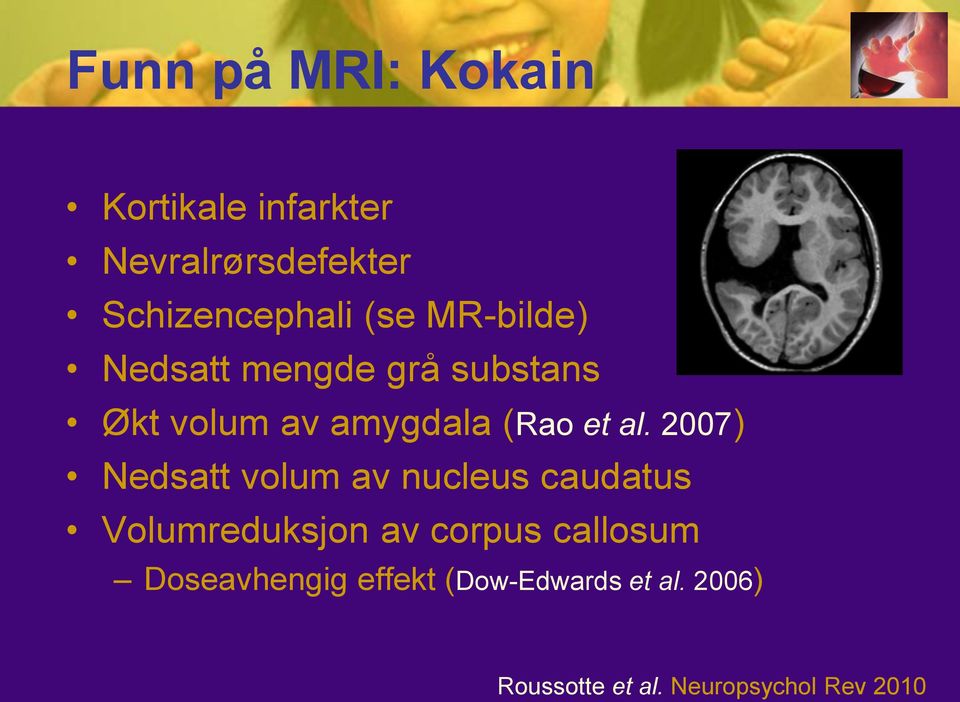 2007) Nedsatt volum av nucleus caudatus Volumreduksjon av corpus callosum