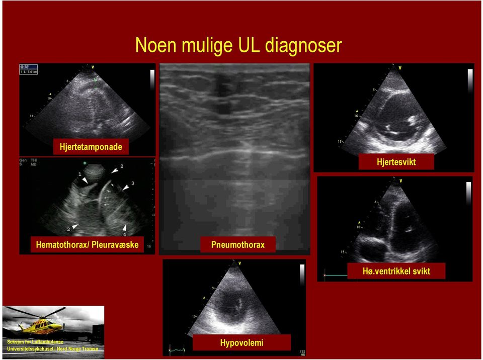 Hematothorax/ Pleuravæske