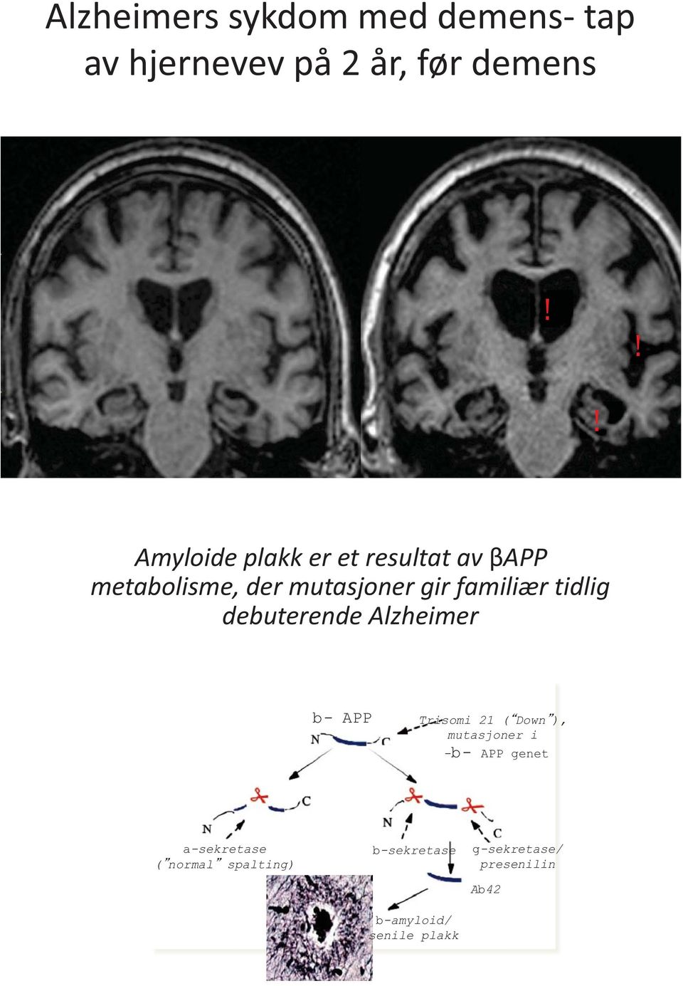 tidlig debuterende Alzheimer b- APP Trisomi 21 ( Down ), mutasjoner i -b- APP