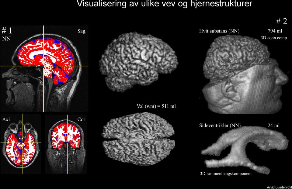 Hvit substans (NN) # 2 794 ml 3D conn.comp.