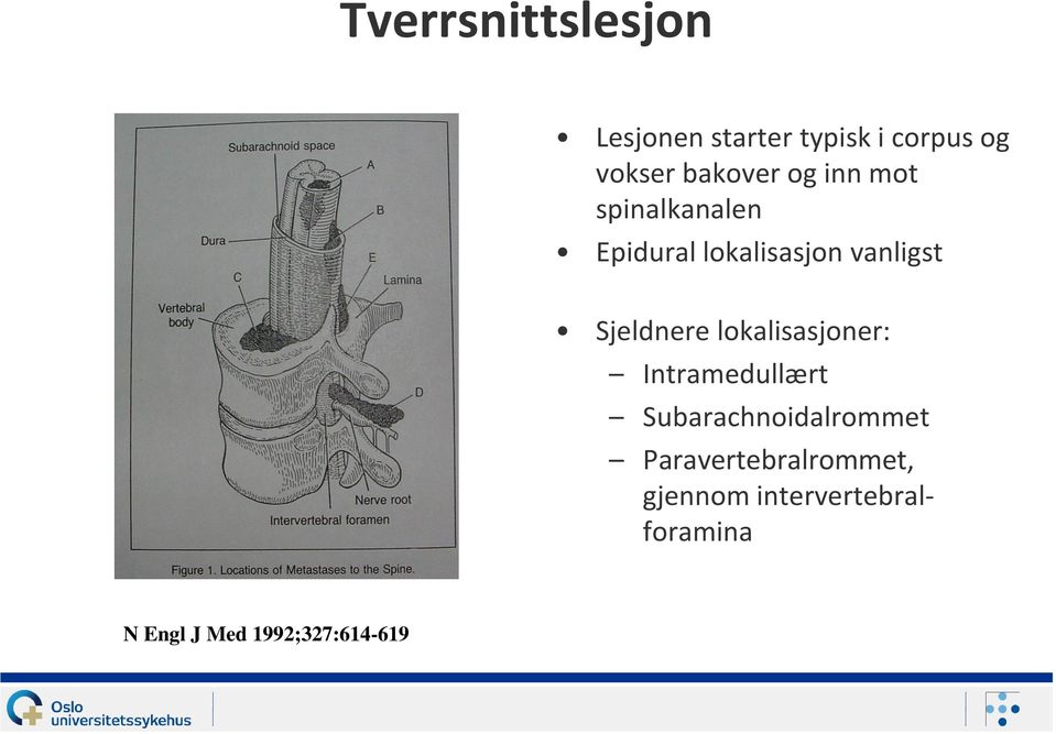 Sjeldnere lokalisasjoner: Intramedullært Subarachnoidalrommet