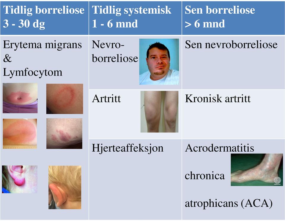 borreliose > 6 mnd Sen nevroborreliose Kronisk artritt