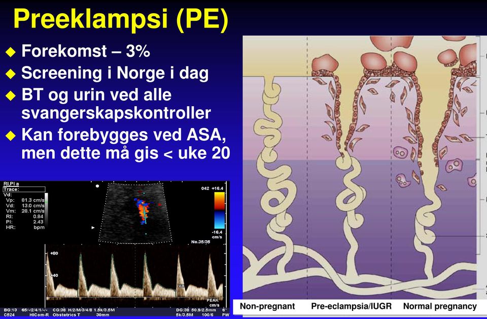 Kan forebygges ved ASA, men dette må gis < uke