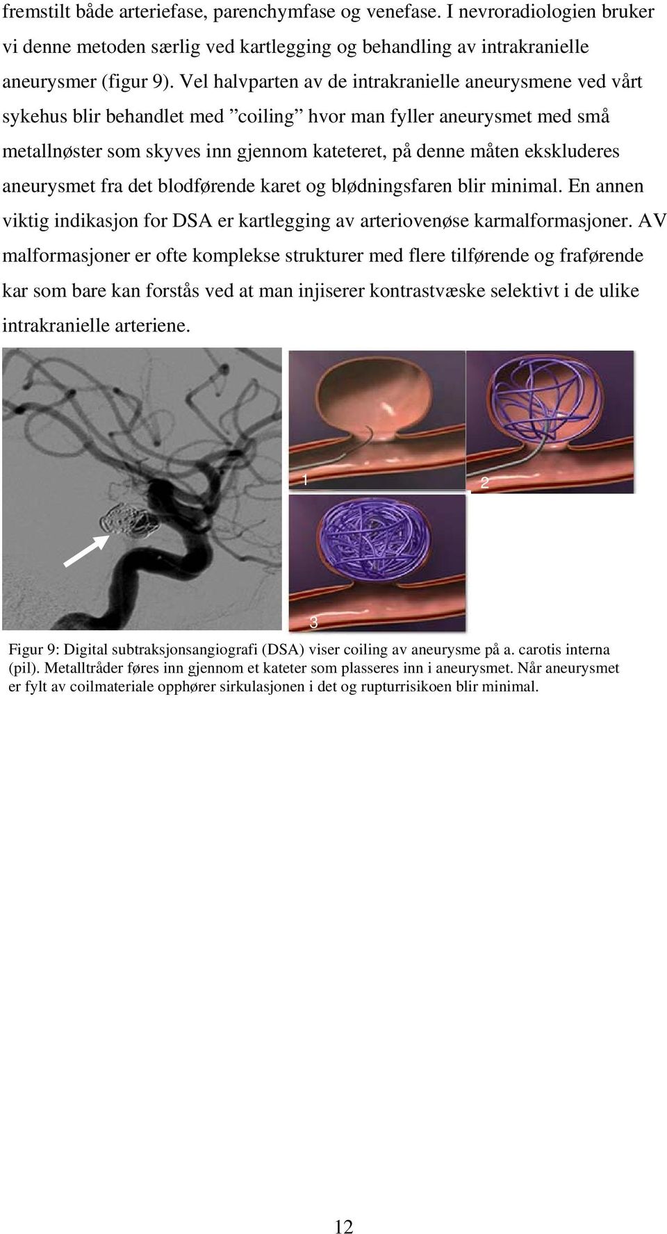 ekskluderes aneurysmet fra det blodførende karet og blødningsfaren blir minimal. En annen viktig indikasjon for DSA er kartlegging av arteriovenøse karmalformasjoner.