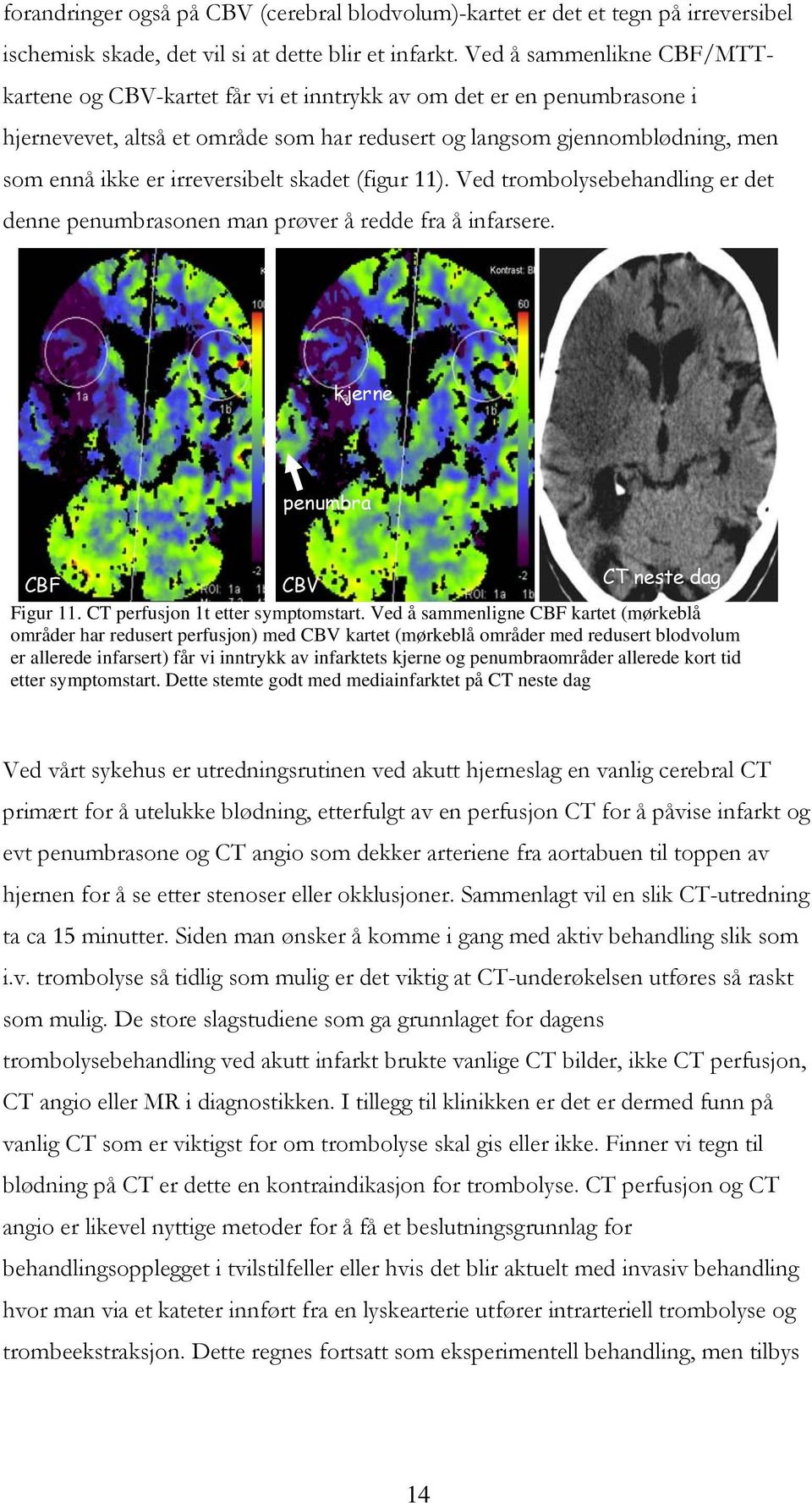 irreversibelt skadet (figur 11). Ved trombolysebehandling er det denne penumbrasonen man prøver å redde fra å infarsere. kjerne penumbra CBF CBV CT neste dag Figur 11.