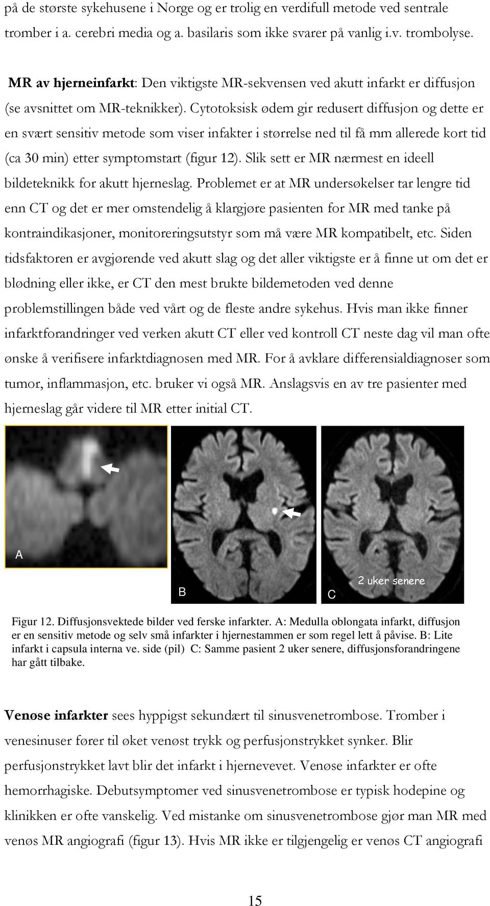 Cytotoksisk ødem gir redusert diffusjon og dette er en svært sensitiv metode som viser infakter i størrelse ned til få mm allerede kort tid (ca 30 min) etter symptomstart (figur 12).