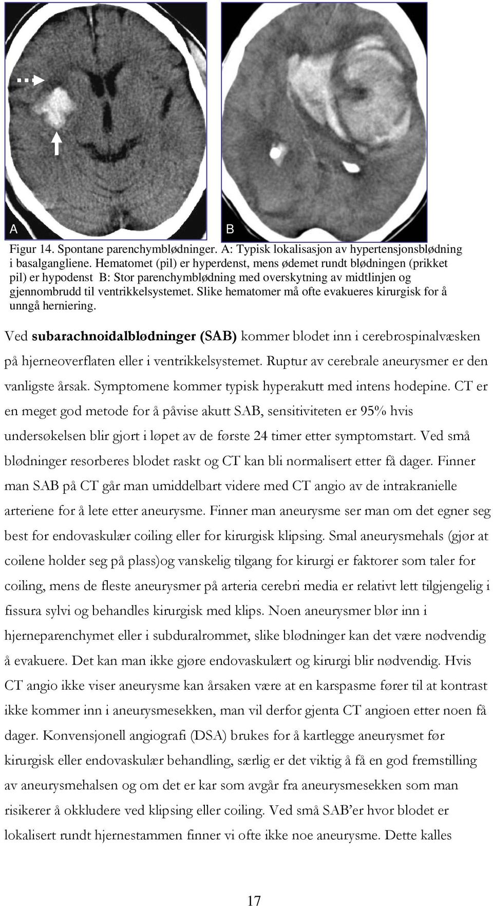 Slike hematomer må ofte evakueres kirurgisk for å unngå herniering. Ved subarachnoidalblødninger (SAB) kommer blodet inn i cerebrospinalvæsken på hjerneoverflaten eller i ventrikkelsystemet.