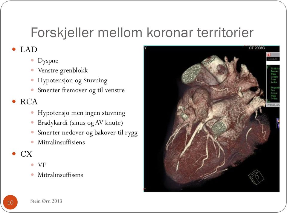 Hypotensjo men ingen stuvning Bradykardi (sinus og AV knute)