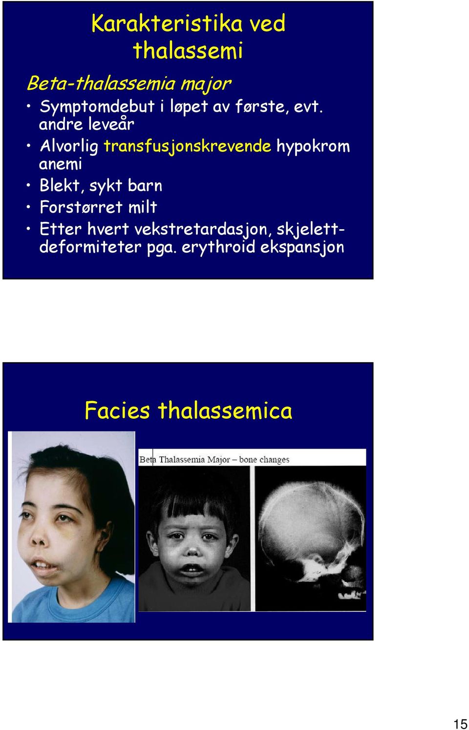 andre leveår Alvorlig transfusjonskrevende hypokrom anemi Blekt, sykt