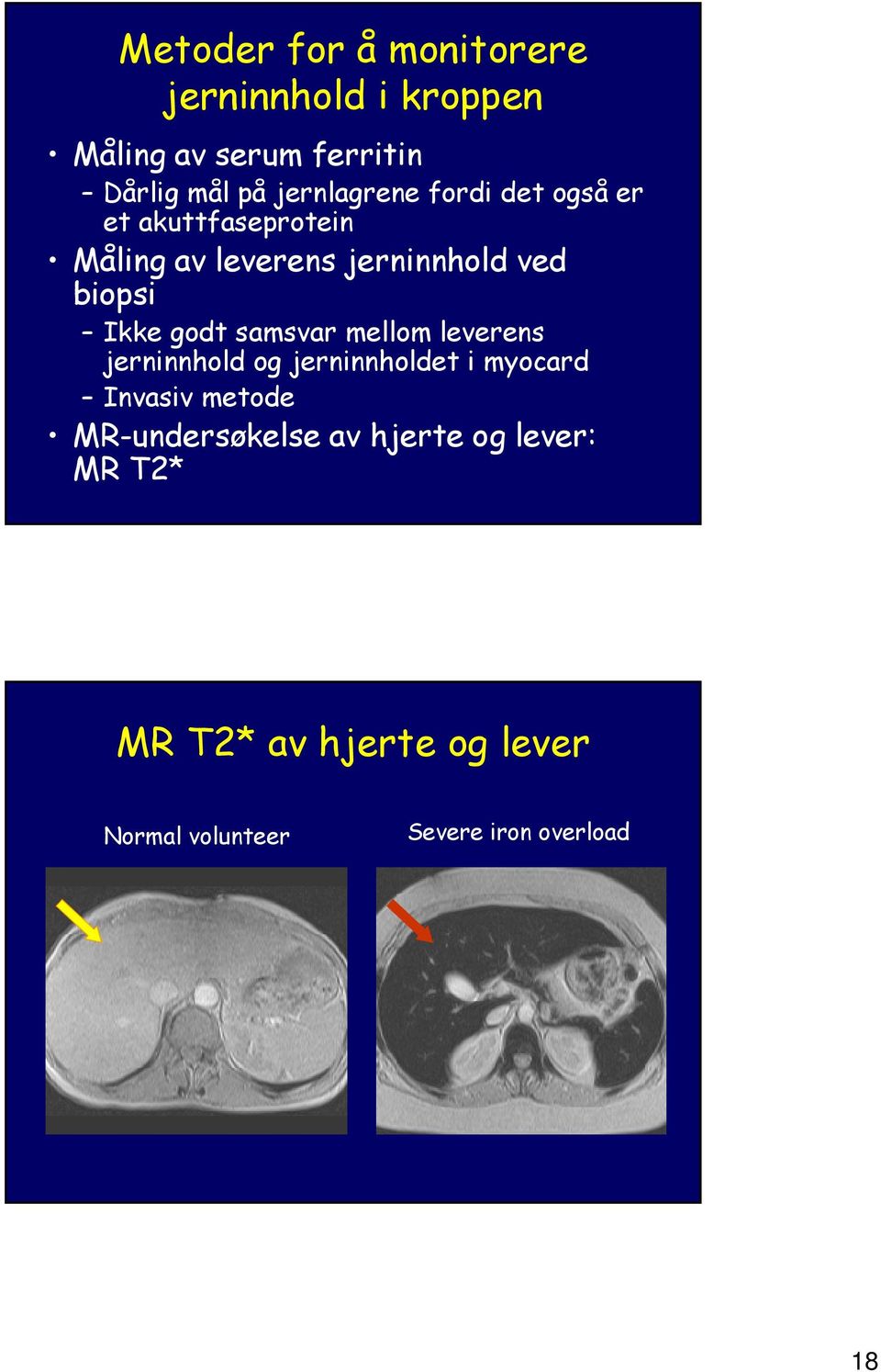 Ikke godt samsvar mellom leverens jerninnhold og jerninnholdet i myocard Invasiv metode