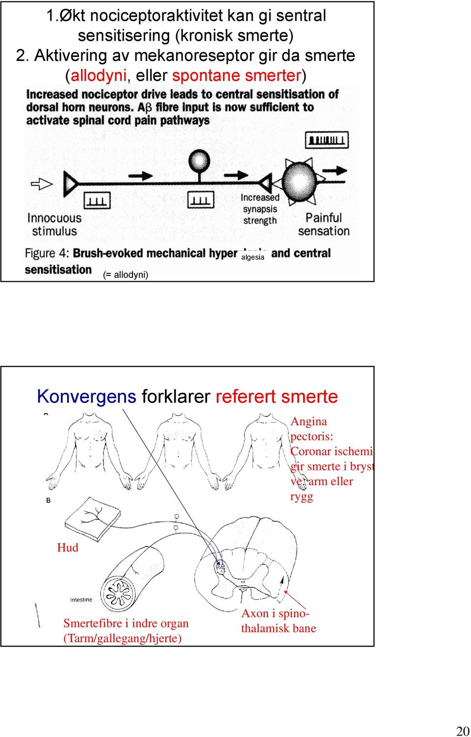 algesia Konvergens forklarer referert smerte Angina pectoris: Coronar ischemi gir smerte i