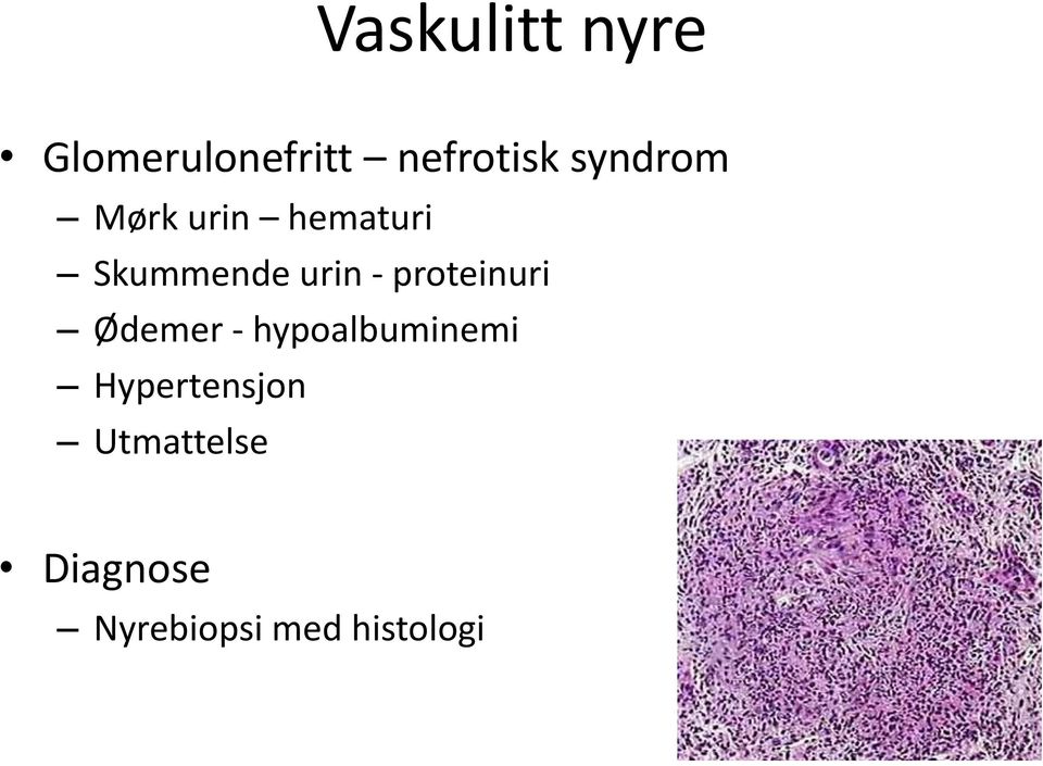 proteinuri Ødemer - hypoalbuminemi