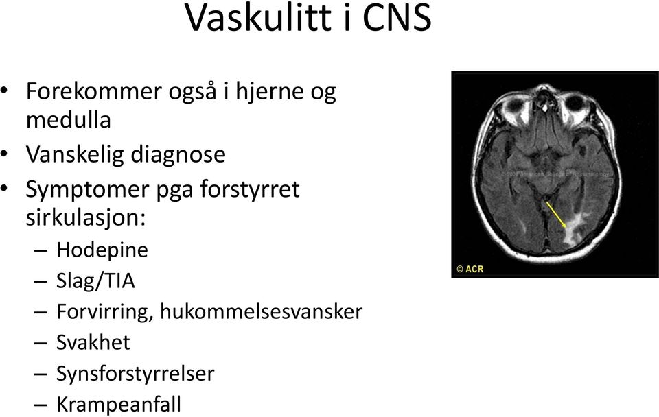 forstyrret sirkulasjon: Hodepine Slag/TIA