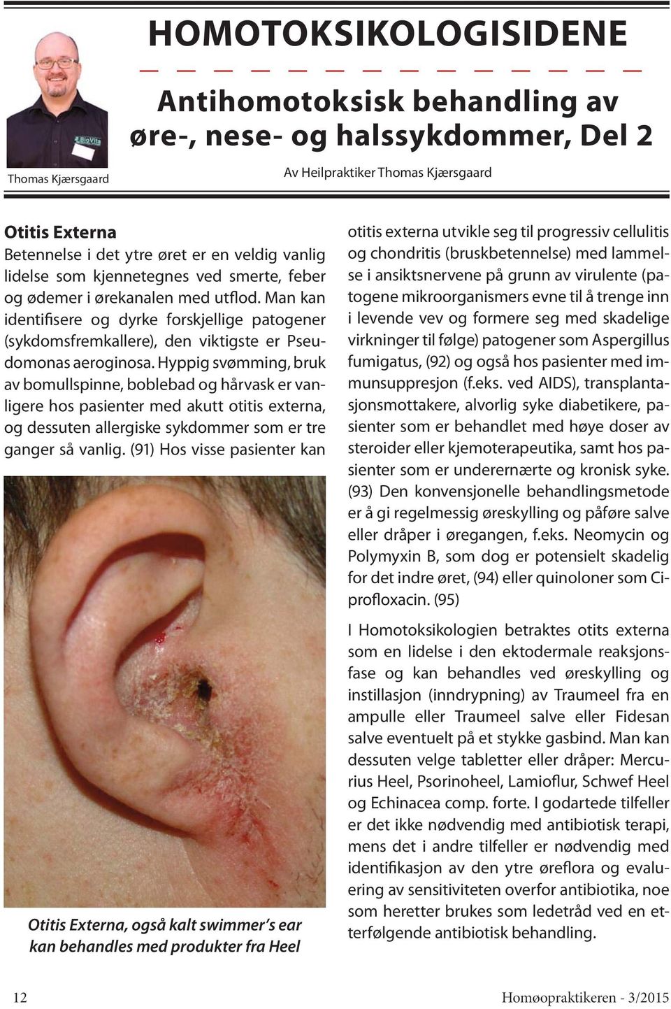 Hyppig svømming, bruk av bomullspinne, boblebad og hårvask er vanligere hos pasienter med akutt otitis externa, og dessuten allergiske sykdommer som er tre ganger så vanlig.