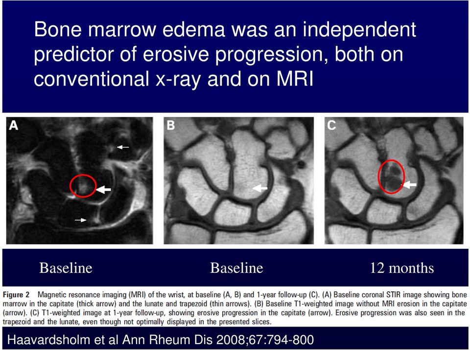 x-ray and on MRI Baseline Baseline 12 months