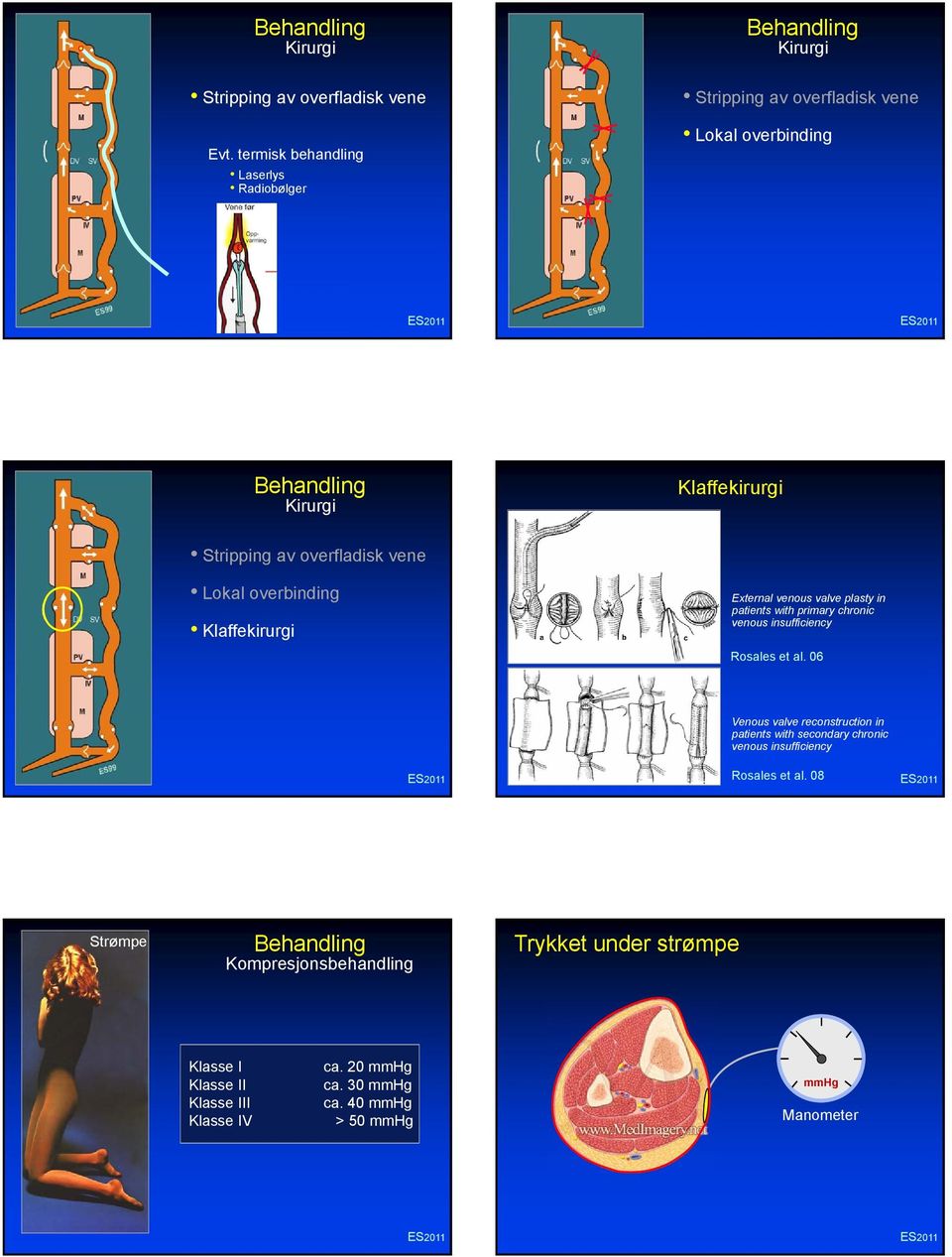 av overfladisk vene Lokal overbinding Klaffekirurgi External venous valve plasty in patients with primary chronic venous insufficiency Rosales et al.