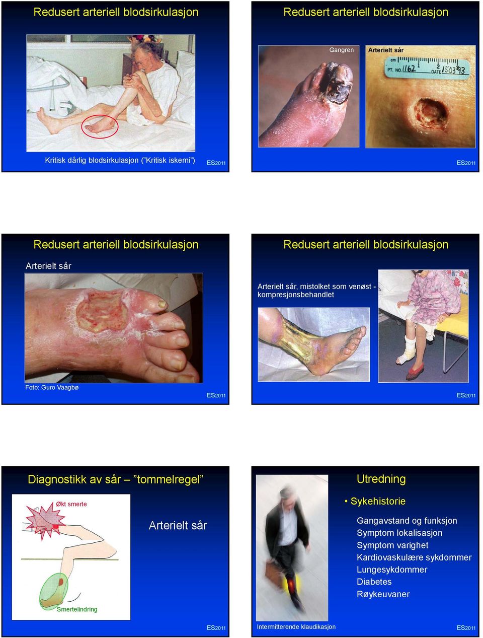 kompresjonsbehandlet Foto: Guro Vaagbø Diagnostikk av sår tommelregel Økt smerte Arterielt sår Utredning Sykehistorie Gangavstand og