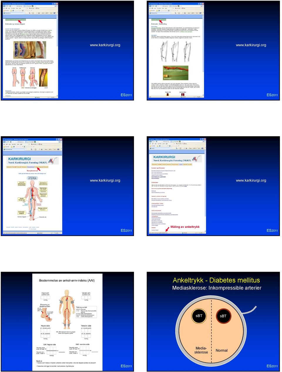 Diabetes mellitus Mediasklerose: Inkompressible