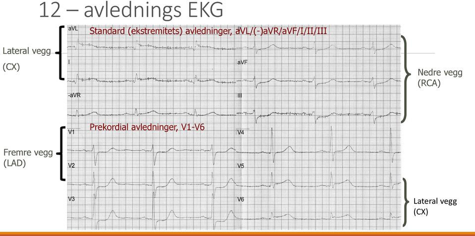 avl/(-)avr/avf/i/ii/iii (CX) Nedre vegg