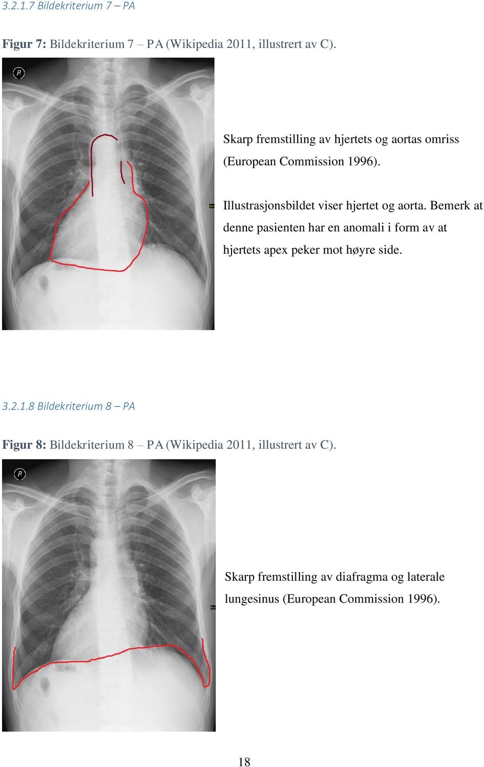Bemerk at denne pasienten har en anomali i form av at hjertets apex peker mot høyre side. 3.2.1.