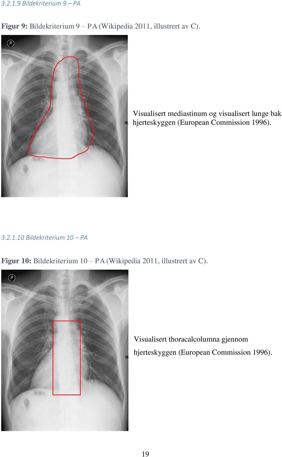 Visualisert mediastinum og visualisert lunge bak hjerteskyggen (European Commission 1996).