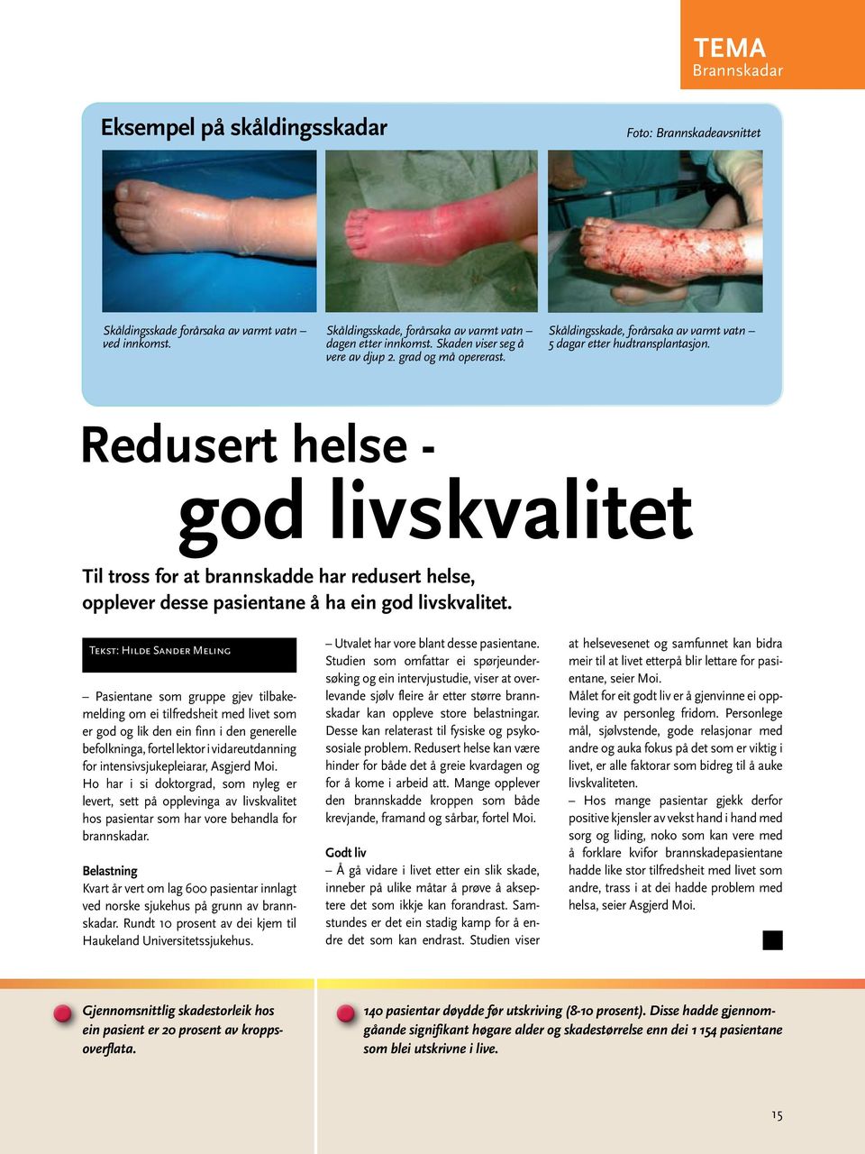 Redusert helse - god livskvalitet Til tross for at brannskadde har redusert helse, opplever desse pasientane å ha ein god livskvalitet.