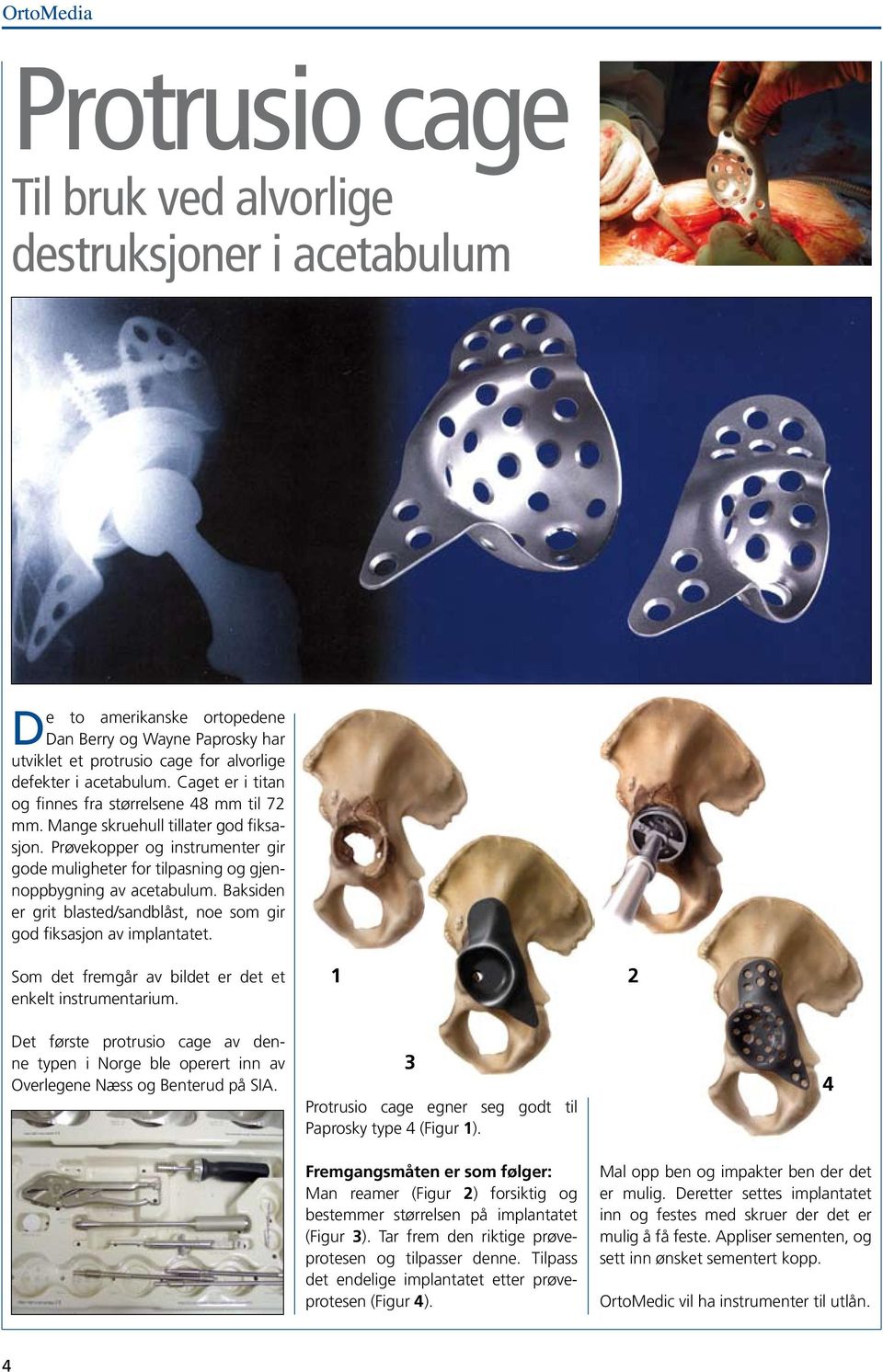 Baksiden er grit blasted/sandblåst, noe som gir god fiksasjon av implantatet. Som det fremgår av bildet er det et enkelt instrumentarium.