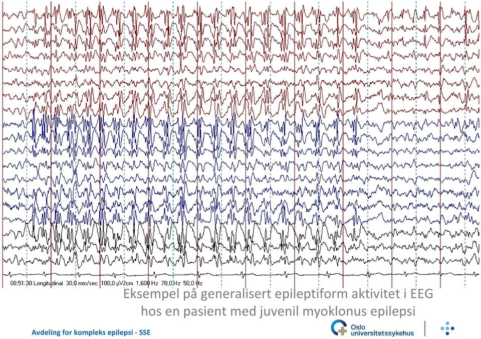 EEG hos en pasient med