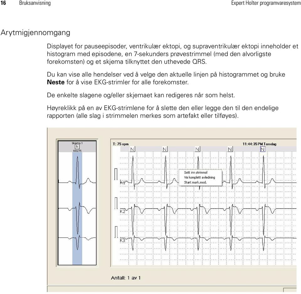 Du kan vise alle hendelser ved å velge den aktuelle linjen på histogrammet og bruke Neste for å vise EKG-strimler for alle forekomster.